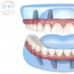 Group logo of Dental Implants: A Permanent Solution to Missing Teeth by DoctorPrem